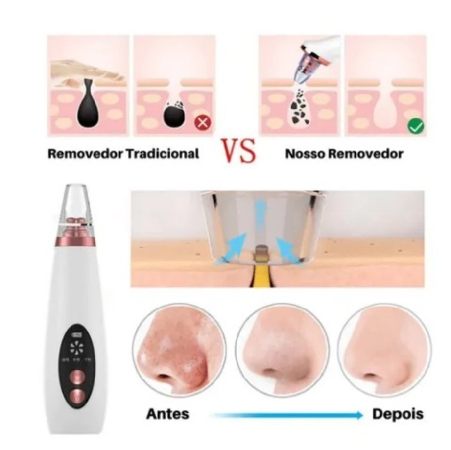 Removedor De Cravos E Poros Elétrico Recarregável Usb Com 6 Pontas De Limpeza