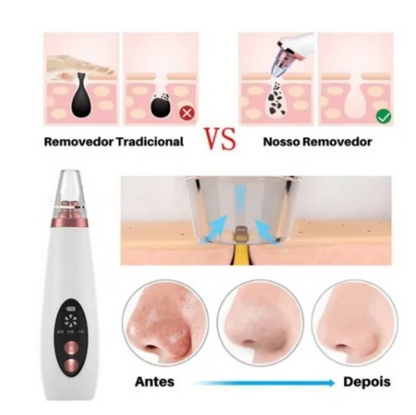 Removedor De Cravos E Poros Elétrico Recarregável Usb Com 6 Pontas De Limpeza